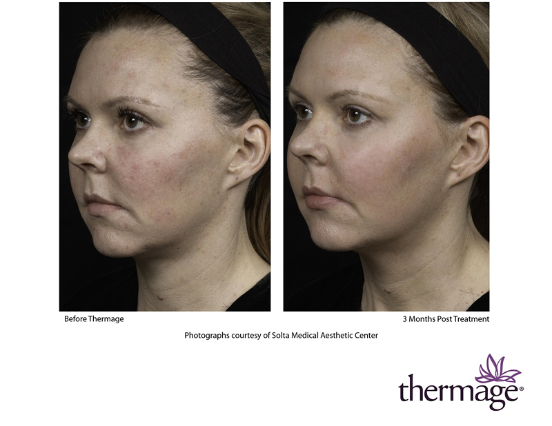 THERMAGE CPT RF Skin Tightening in Markham