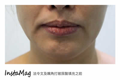 Dermal Filler injection in Markham